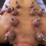 Myofascial Cupping + Sports Massage